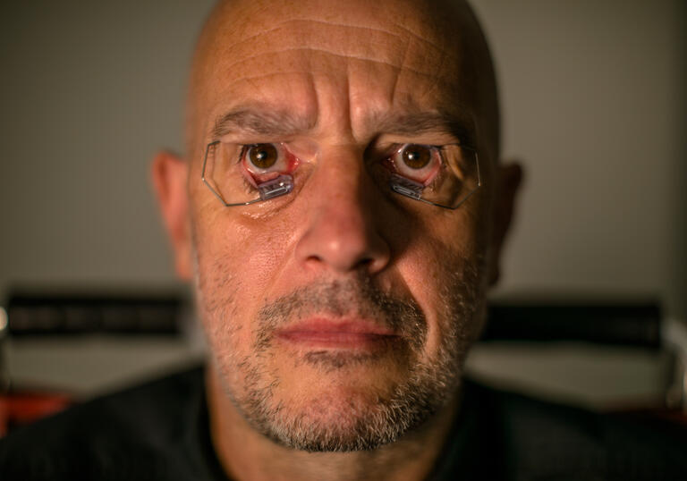 A middle aged man stares directly ahead, with stints in his eyes holding them open.